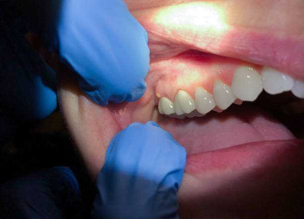Best Emergency Denture Repair in English Creek, NJ